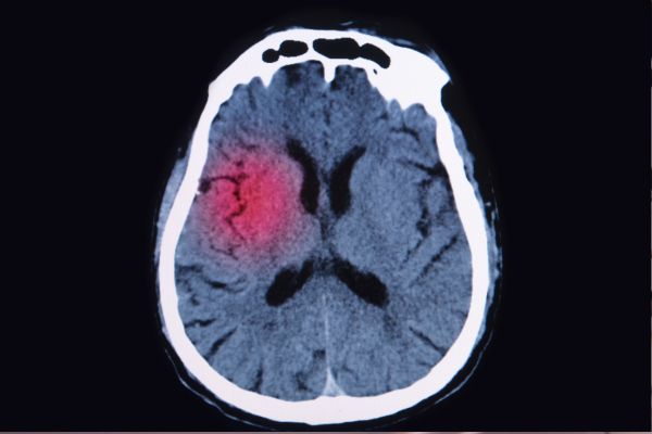 Aneurismas Cerebrales: Prevención, Tratamiento y Qué Hacer en Caso de Ruptura