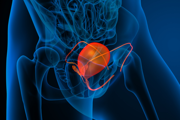 Qué esperar ante un diagnóstico de cáncer de vejiga