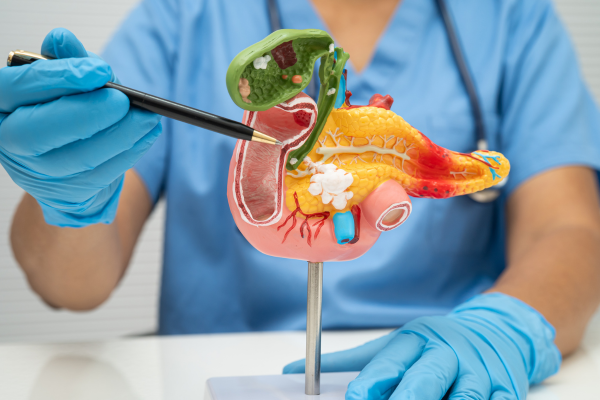 Un estudio de Mayo Clinic revela que la quimioterapia antes de la cirugía mejora la supervivencia en cáncer de páncreas temprano