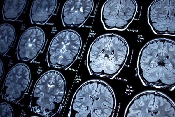 Avances en el tratamiento de la epilepsia: innovación tecnológica y atención personalizada